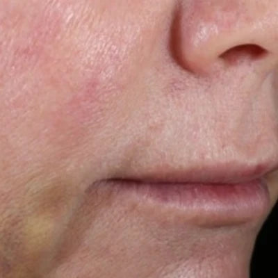 ALASTIN INHANCE® Serum 10mL clinical result after image two