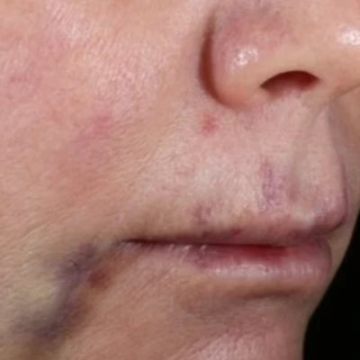 ALASTIN INHANCE® Serum 10mL clinical result before image two