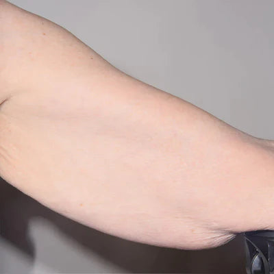 ALASTIN TransFORM Body Complex™ 170g clinical result after image one